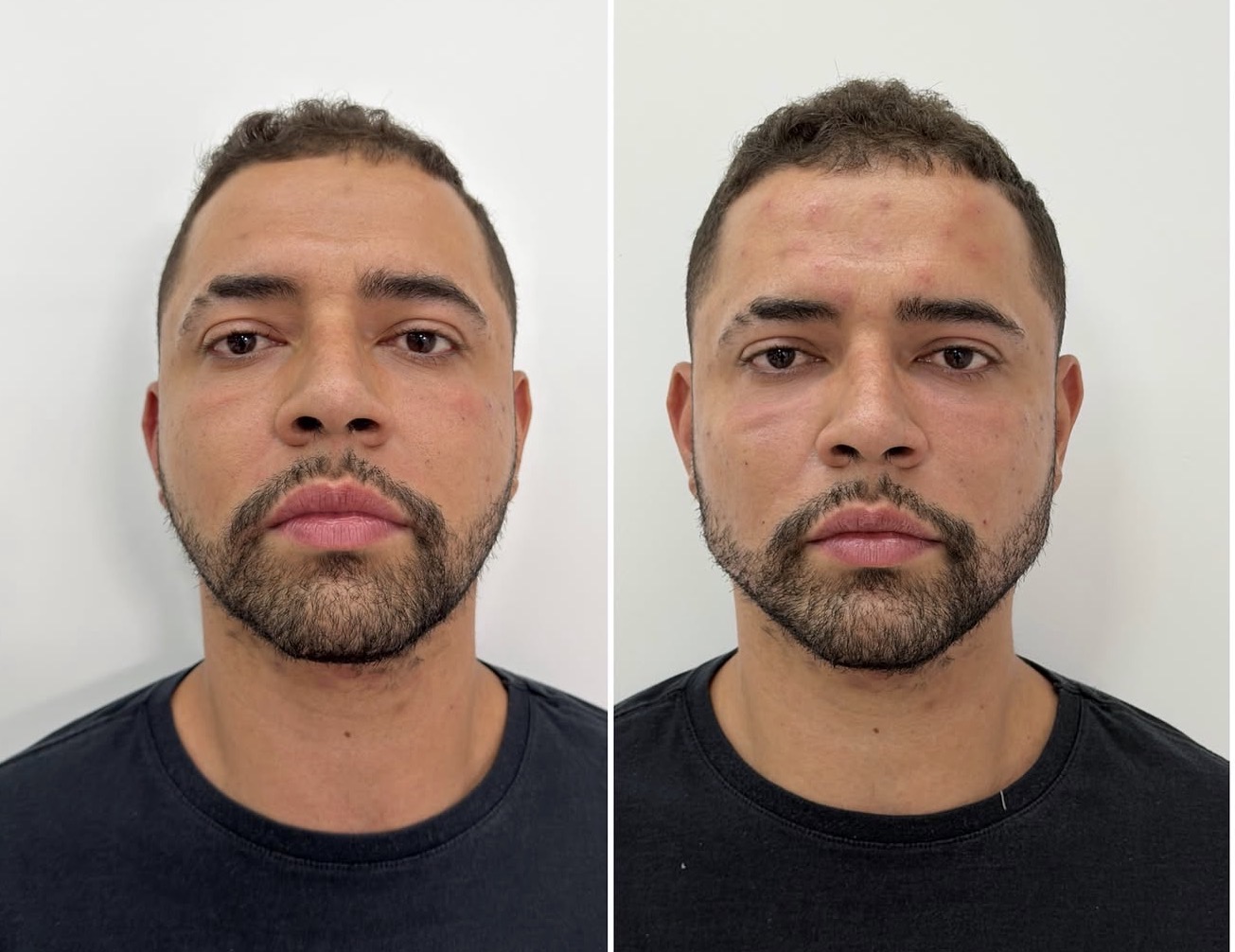 Resultado Velora Clínic — Harmonização Facial