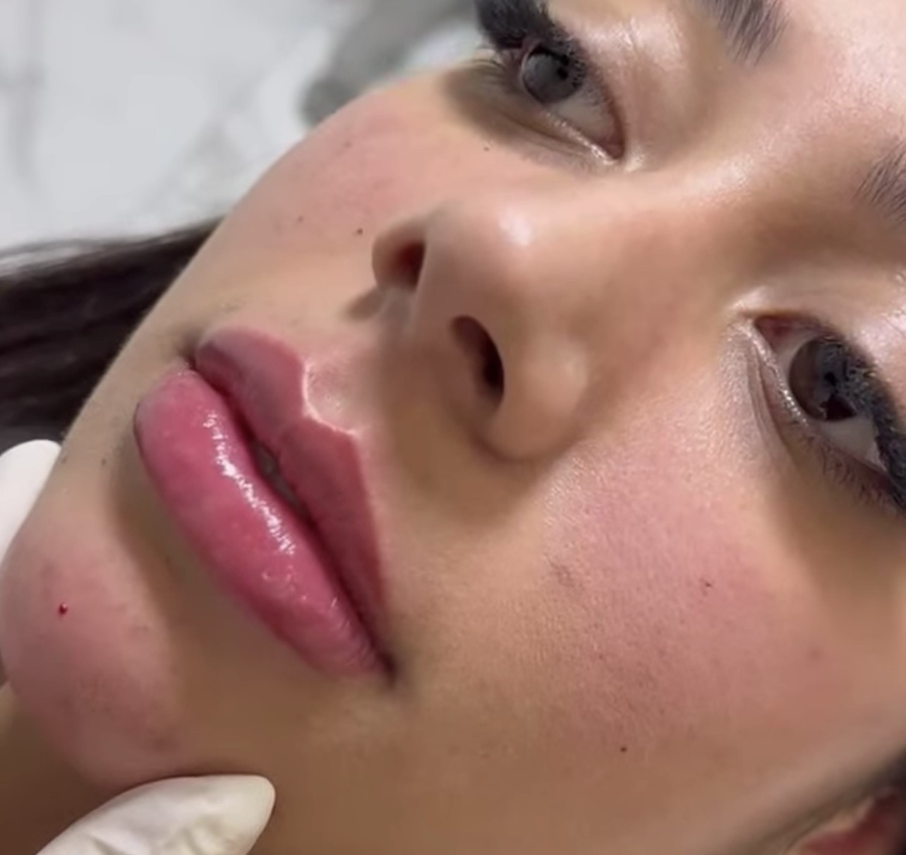Resultado Velora Clínic — Preenchimento Labial