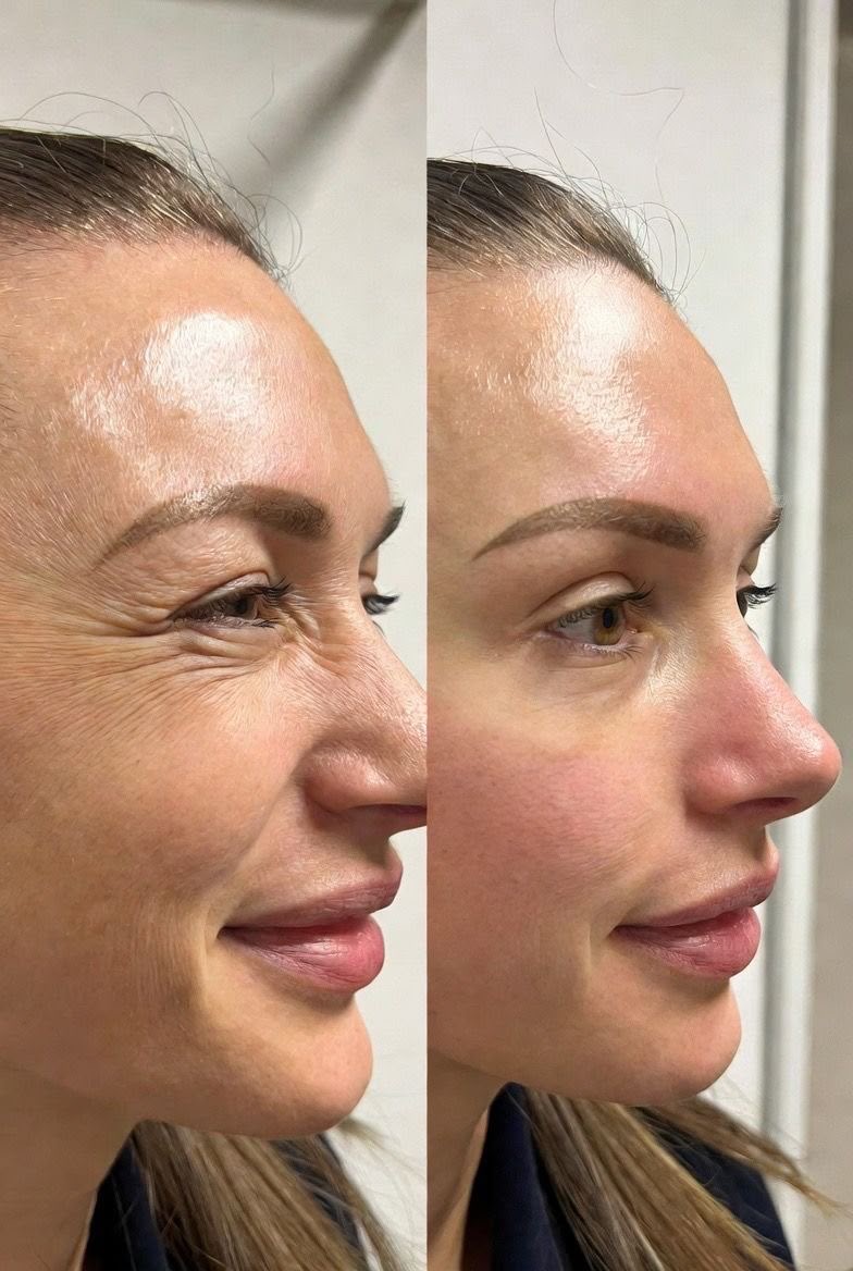 Resultado Velora Clínic — Botox