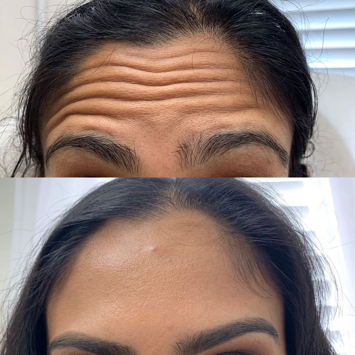 Resultado Velora Clínic — Botox