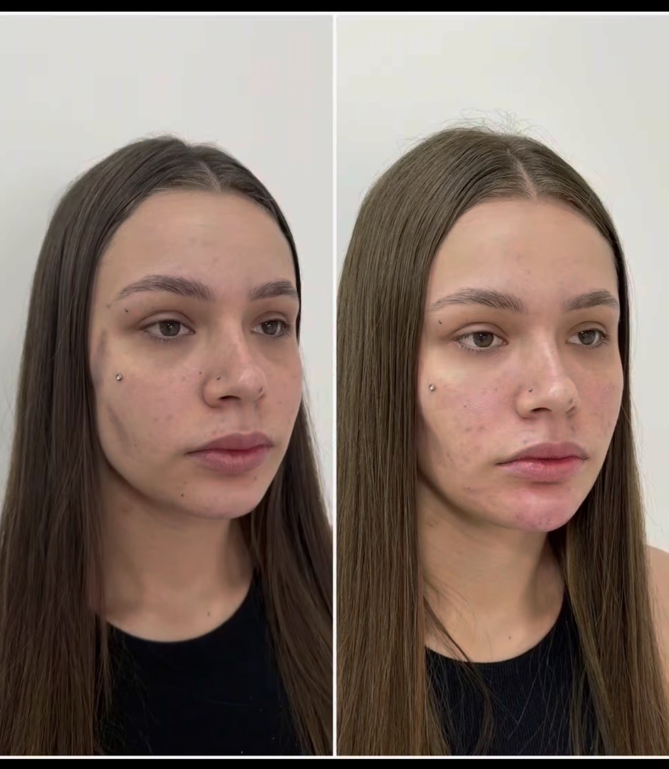 Resultado Velora Clínic — Harmonização Facial