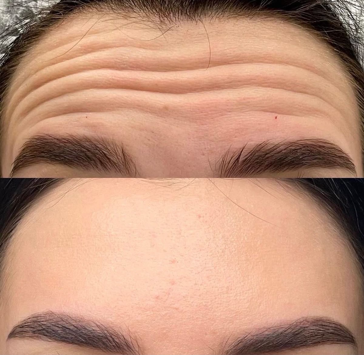Resultado Velora Clínic — Botox